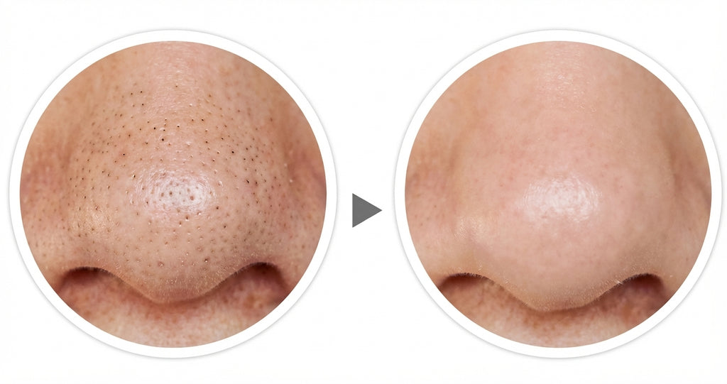 Succionador de poros